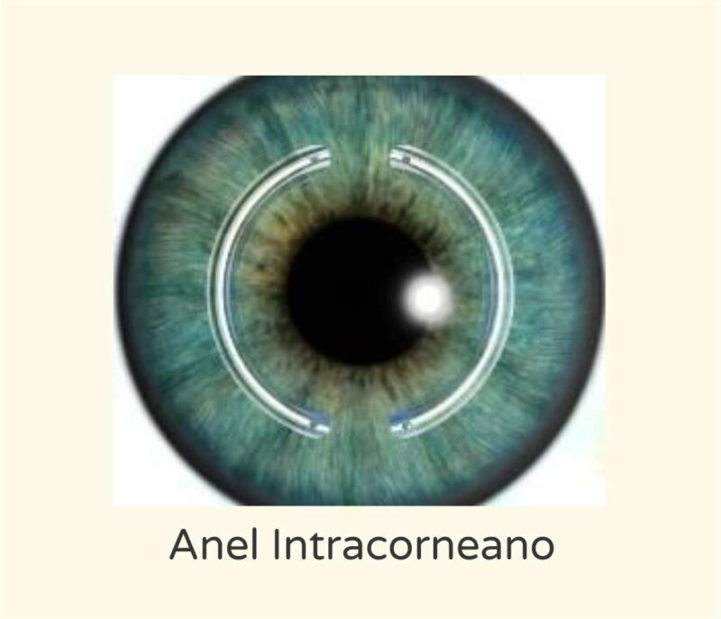 Anel intracorneano - Instituto de Olhos de Florianópolis