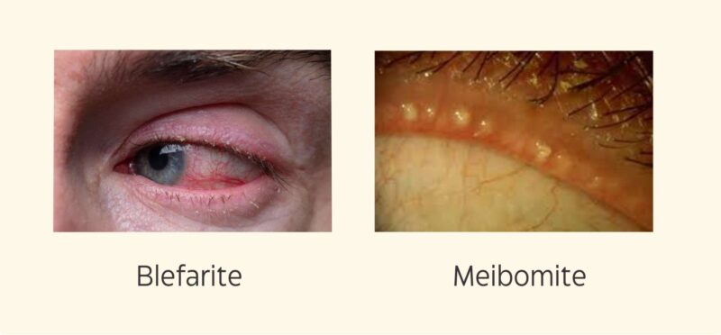 Blefarite: quais são as causas, consequências e tratamento? – Instituto de  olhos de Florianópolis