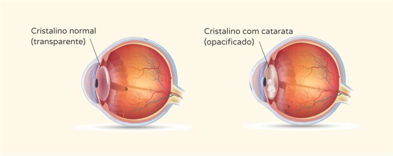 Catarata Sintomas e tratamento - Instituto de Olhos de Florianópolis