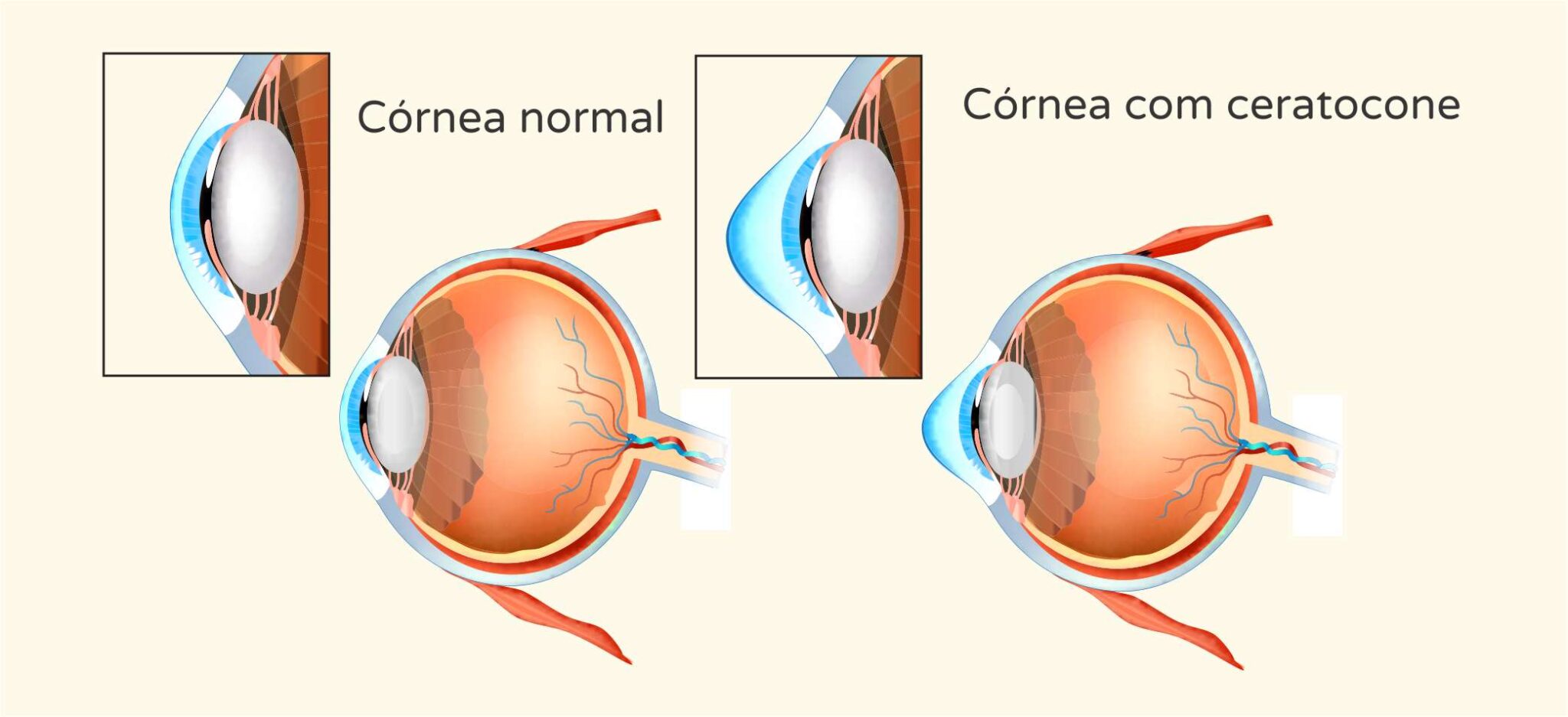 Ceratocone tem cura? – Instituto de olhos de Florianópolis