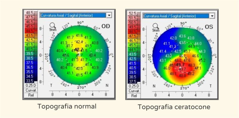 Topografia ceratocone - Instituto de Olhos de Florianopolis