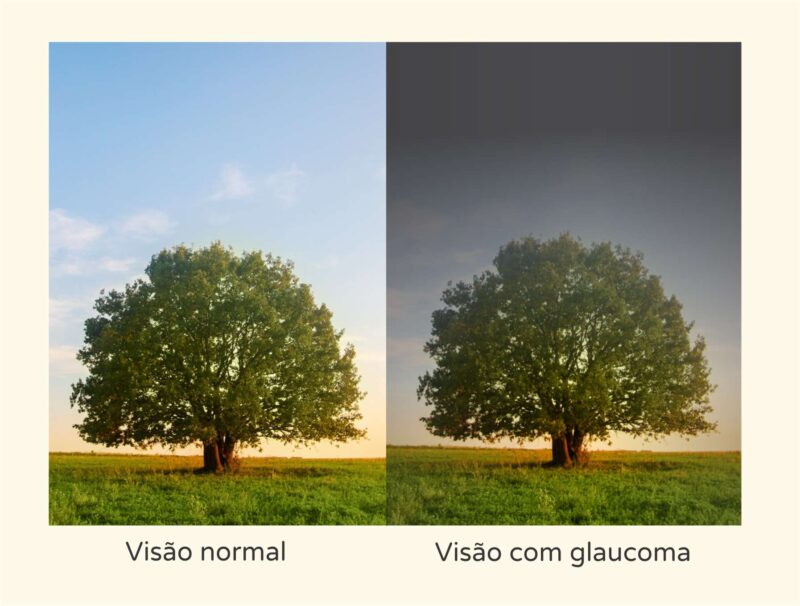 visao com glaucoma - Instituto de Olhos de Florianópolis